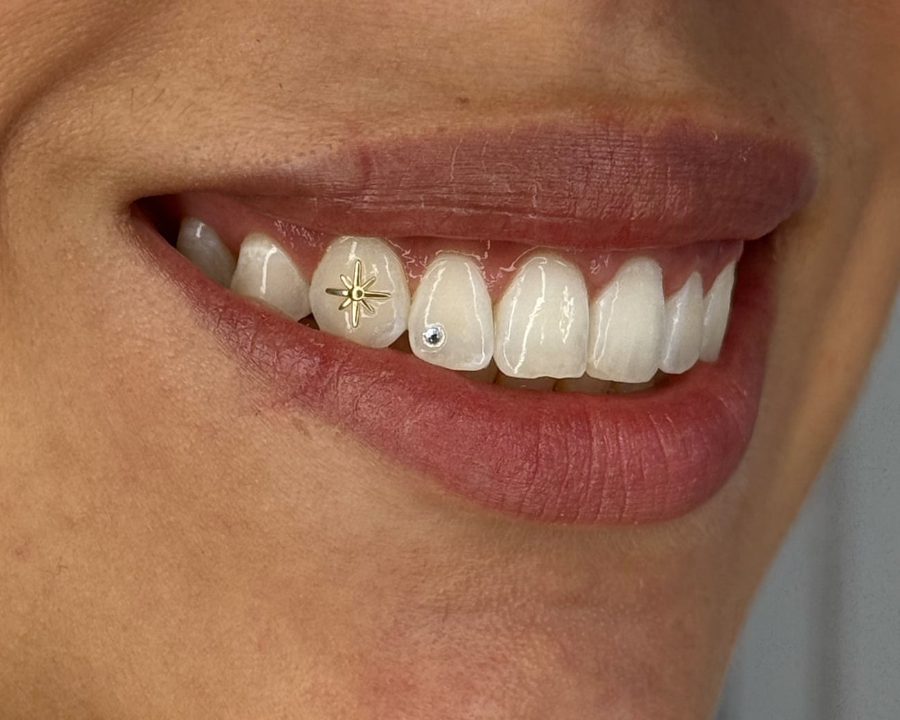 Youthful Australians are aligning for tooth treasures. Are blinged smiles safe, or an oral calamity?